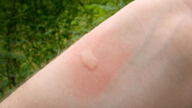 imagen El mito de la sangre dulce: los mosquitos pican por el olor a pie